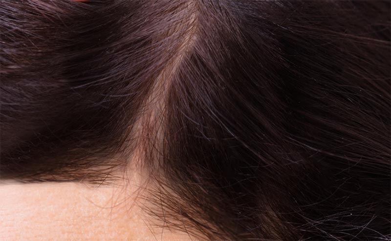 Female Hair After Xcellerate35